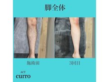 アクト クロ(ACT curro)/【脚全体】脱毛施術例