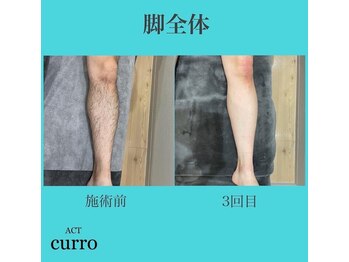 アクト クロ(ACT curro)/【脚全体】脱毛施術例