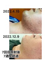 ビーモア(be MoA)/ヒゲだけでなく美肌も目指せる！