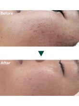 サロンド エステ ミニョン(salon de esthe mignon)/肌荒れ改善