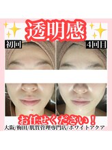 ホワイトアクア 梅田本店(WHITE AQUA)/ハーブピーリング/大阪/梅田