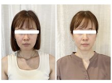 ウォーブ(Wobe)/施術3回の変化!お顔が小さく