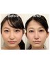 【回数券利用】5回・10回 隆鼻+リフトアップ+輪郭・小顔矯正50分 