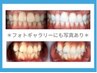【ホワイトニング◇効果実感◎】ホワイトニング20分×2回￥12,450→￥9,960