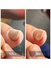 【深爪の方はこちら◎】巻き爪矯正（1爪）カウンセリング込み60分