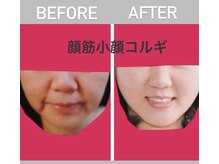 小顔骨気専門サロン パトラ(PATORA)/小顔コルギBefore＆After