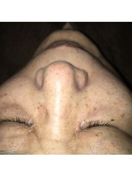 グリーンノート(GREEN NOTE)/鼻の毛穴の汚れ