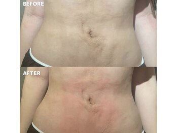 エッセンスビー 六本木/お腹の吸引ケア