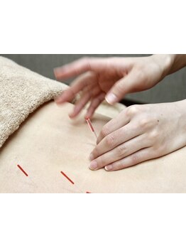 鍼灸施術を受けたい