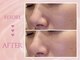 クリアラボ 川崎(Clear Lab)の写真/【韓国肌管理"ララピール"】SNSで話題沸騰！剥離とダウンタイムのない次世代ピーリングで憧れの水光肌に★