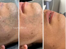 リンネ(Rin'ne)/[メンズ髭脱毛] 驚きの効果！