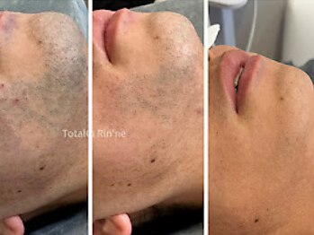 リンネ(Rin'ne)/[メンズ髭脱毛] 驚きの効果！