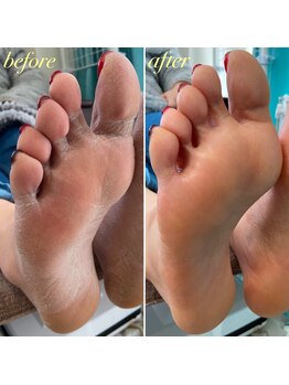 フット角質ごっそりオフ