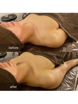 ルミエール(Lumiere)/【倉敷市】バストアップ施術事例