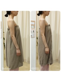 ルノン(Lunon)/《不調改善》巻き肩・猫背調整　