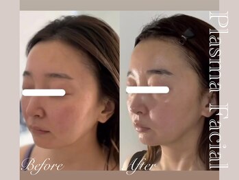 ミリュール(Millule)/美筋リフト×プラズマ