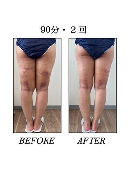 ファミーユ 新宿店/【インディバ太ももケア】