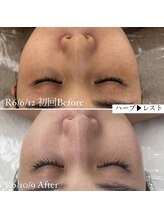 ミエル 神戸店(Miel)/リアボーテ　エステメニュー