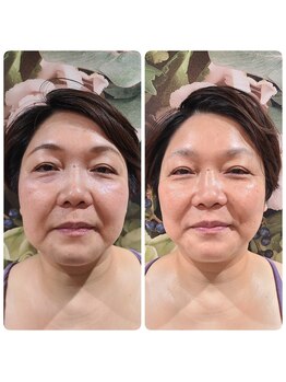 ピーチ(Peach)/小顔リンパ