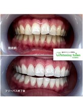 ホワイトニングサロン 名古屋駅店/【ホワイトニング施術例】