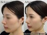 頭皮リフト【顔のたるみ改善】再生美容¥44,000→33000