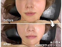 深部温熱×EMSで、たるみを引き上げ即実感リフトアップ小顔