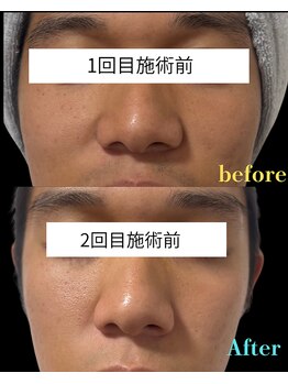 ノエル(Noel)/メンズセラピール症例