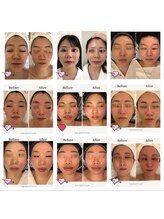 ナラビューティー(NARA BEAUTY)/NARA の小顔コルギ