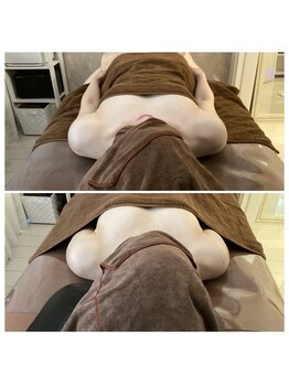 プレミドール(PREMIDOLL)/Before &nbsp;After/施術3回