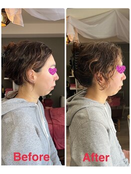 サントーシャ(Santosha)/フェイスラインがスッキリ