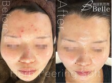 ベル 上野(Belle)/ハーブピーリング|ニキビケア