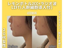 イーラボ 池袋店(e-LABO)/レモンボトル+ラジオ波Lift