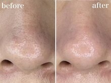 ホワイトアクア 浜松店(WHITE AQUA)/ララピール/ニキビケア