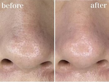 ホワイトアクア 浜松店(WHITE AQUA)/ララピール/ニキビケア