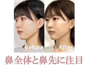 ラプリボーテ(Raplit BEAUTE)/隆鼻＋輪郭矯正40分10回