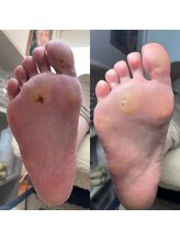 ランランネイル(rangrang nail)/足裏のタコ魚の目ケア