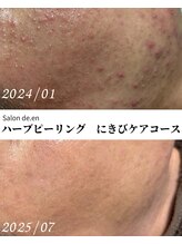 サロン ド エン(Salon de. en)/敏感ニキビ◇ハーブピーリング