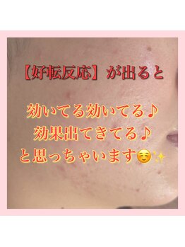 アルムダアクア 天王寺店(Aleumda AQUA)/ハーブピーリング/大阪/天王寺