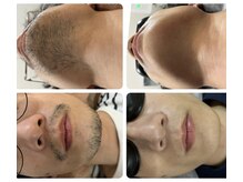 シエロ アンド フラーラ(CIELO | HULA LA)の雰囲気（ヒゲ脱毛照射4回　4週後の写真ビフォーアフター）