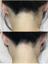 エムズスタイル ネイルバー(M's Style NAIL BAR)/うなじ脱毛