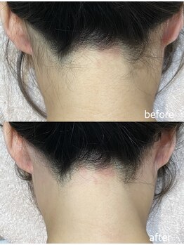 エムズスタイル ネイルバー(M's Style NAIL BAR)/うなじ脱毛