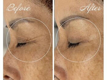 ローズドゥシャロン(Rose de CHALON)/目元のシワ/シミ徹底改善★