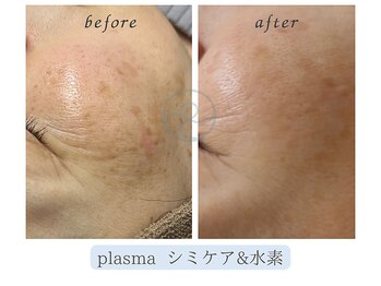小顔×肌質ケア&経絡ヒーリングKimusubi /気になる年齢肌に水素×プラズマ