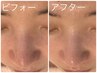 【毛穴・くすみ・ツヤ肌】REVIハーブピーリング
