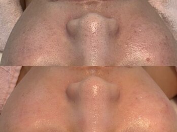 カレンジェビューティー(CarengeBeauty)の写真/【毛穴悩みは一つじゃない】毛穴タイプを見極め、最適な毛穴ケアをご提案♪