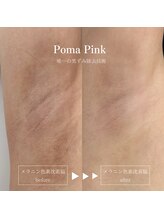 クリニカルボーテ 心斎橋院(CLINICAL BEAUTE)/ローマピンク