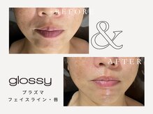 グロッシー(glossy)/【症例】唇・首も含め全顔のケア
