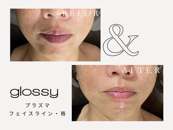 グロッシー(glossy)/【症例】唇・首も含め全顔のケア