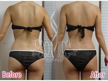 グラウディア 恵比寿/痩身/筋膜リリース/インディバ超