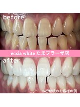 エクシアホワイトニング たまプラーザ店/ビフォーアフター